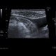 Crohn's disease, acute inflammation, ascites: US - Ultrasound